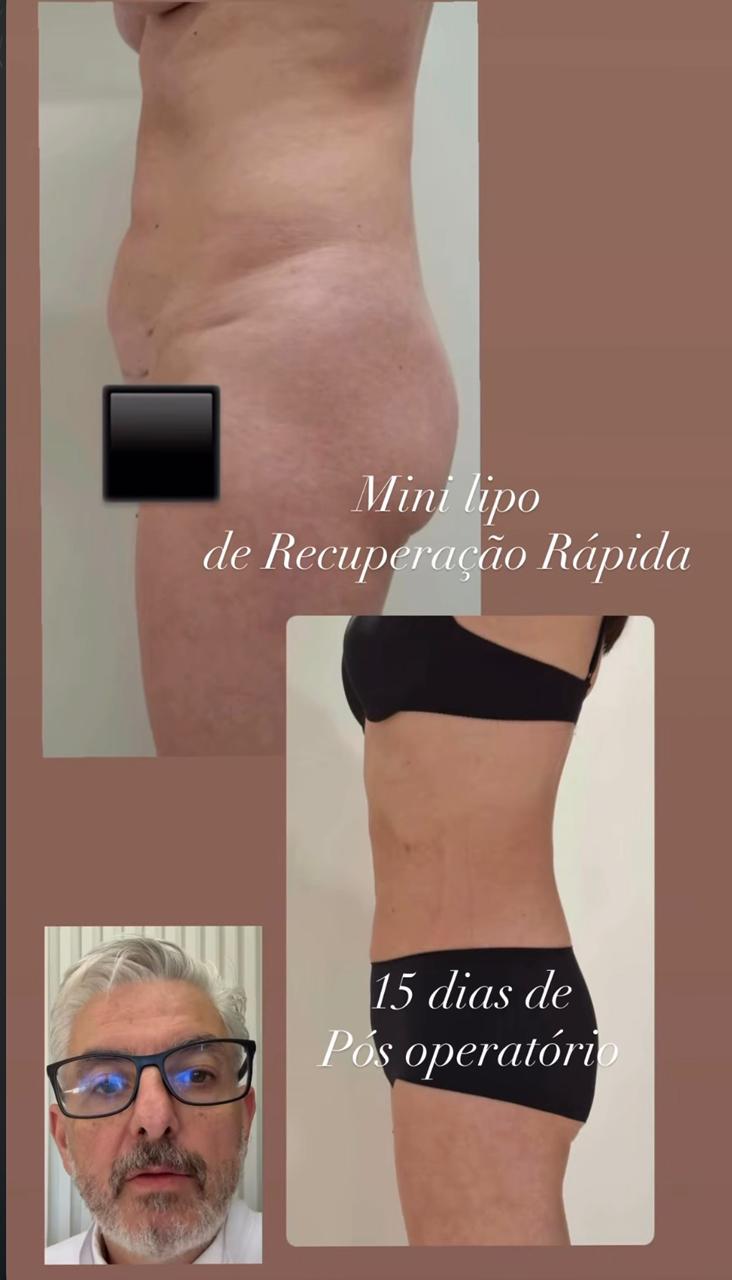 Resultado Mini Lipo - 15 dias pós-operatório